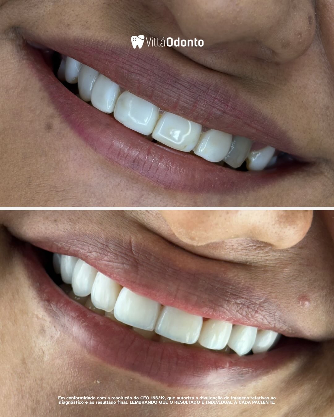 Como Escolher a Escova de Dente Ideal para Facetas