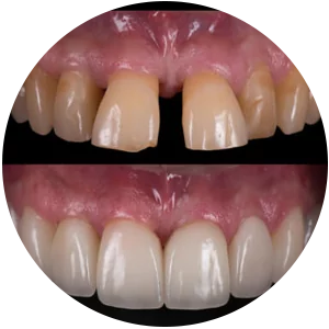 A Importância da Limpeza Interdental para Facetas