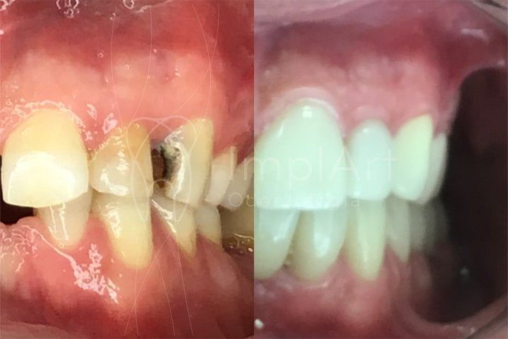 Como evitar a cárie em dentes com implante