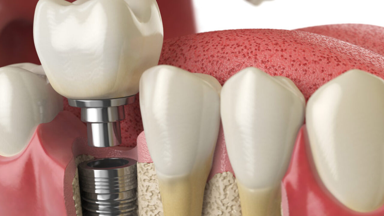 O Que é Peri-implantite e Como Evitá-la