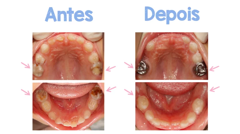Como evitar a cárie em dentes de leite