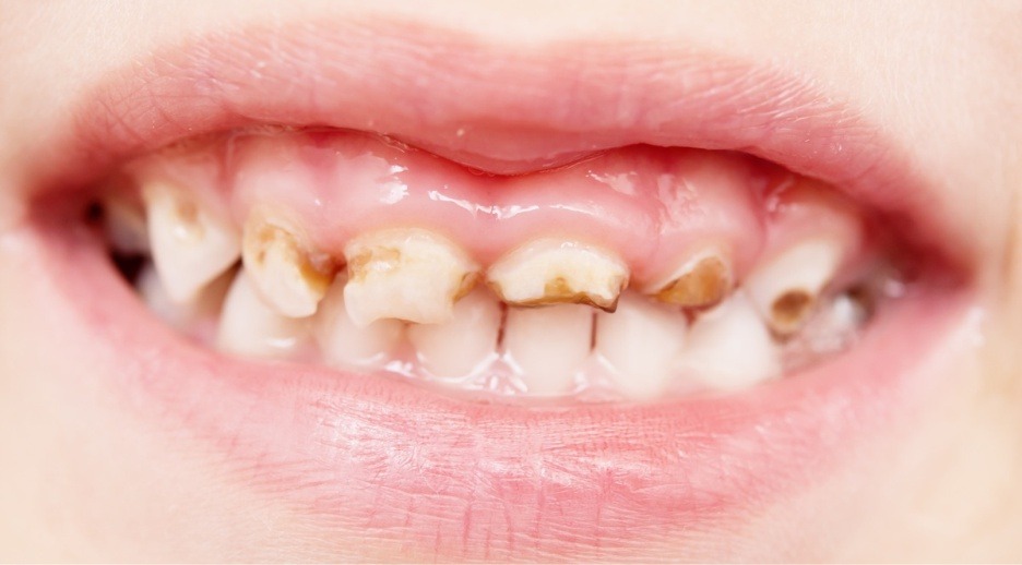 A importância dos selantes dentários para crianças