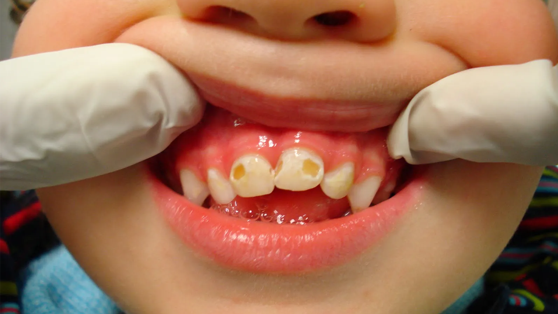 A quantidade certa de pasta de dente para cada idade