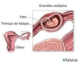 Como o tabagismo afeta a fertilidade e o risco de gravidez ectópica