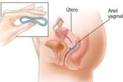 Como evitar a gravidez indesejada com anel vaginal