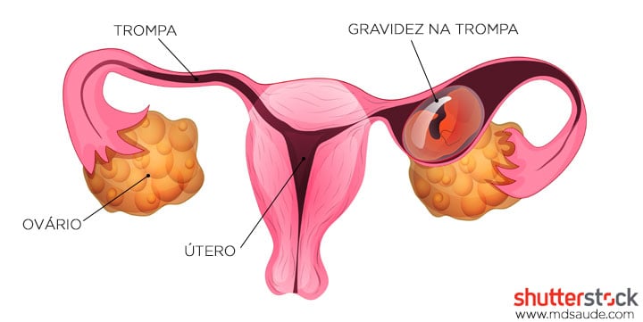 Métodos contraceptivos: qual o mais indicado para você?