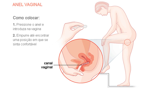 Anel Vaginal: O Que Fazer em Caso de Esquecimento ou Expulsão