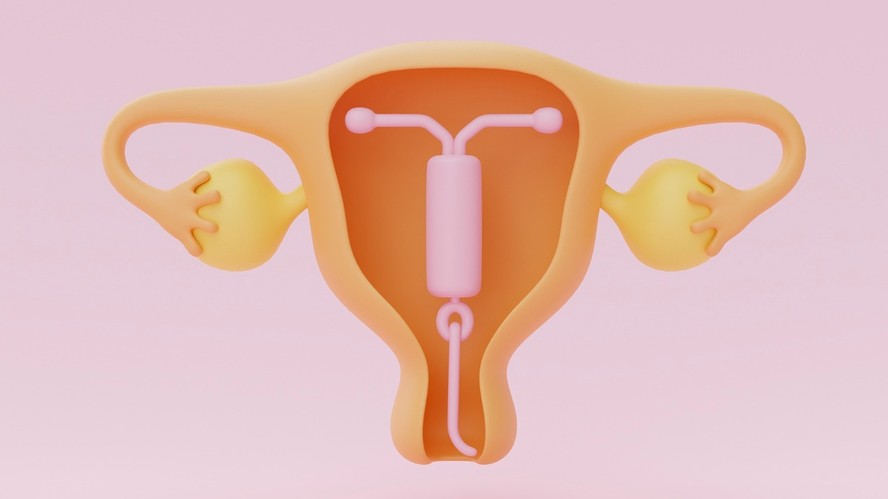 5 Mitos e Verdades sobre o DIU de Cobre