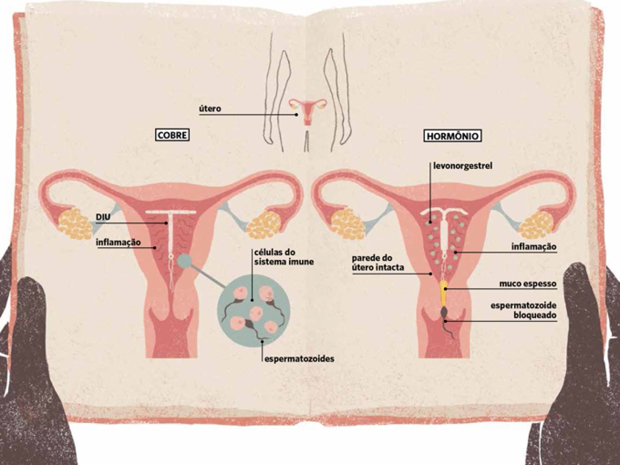 Como Escolher o Melhor DIU para Você: Cobre vs. Hormonal