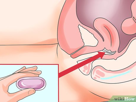 Guia Completo de Métodos Contraceptivos Não Hormonais