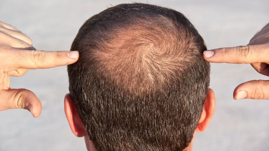 PRP Capilar: O Que É e Como Funciona?