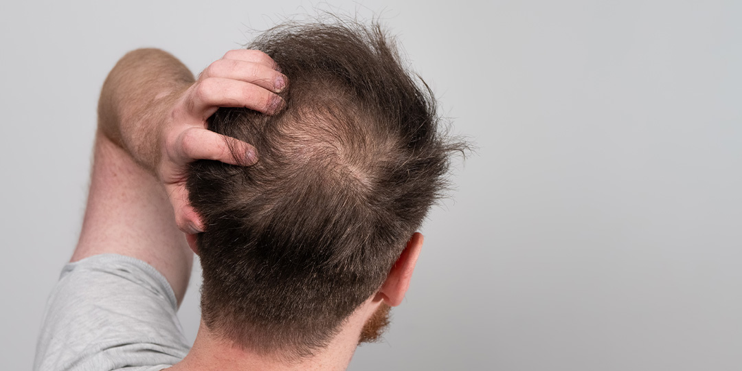 Guia Completo de Minoxidil para Queda de Cabelo