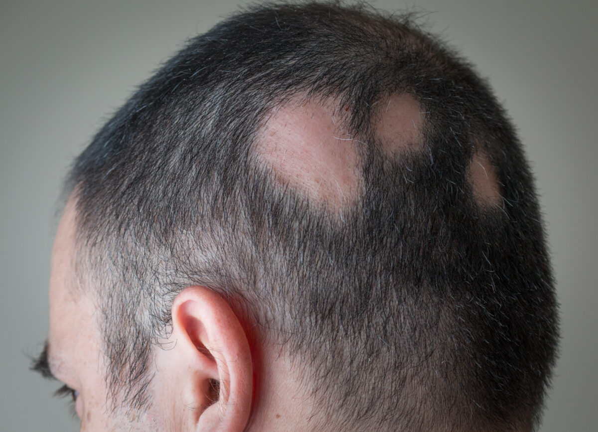 Como evitar a queda de cabelo por alopecia areata