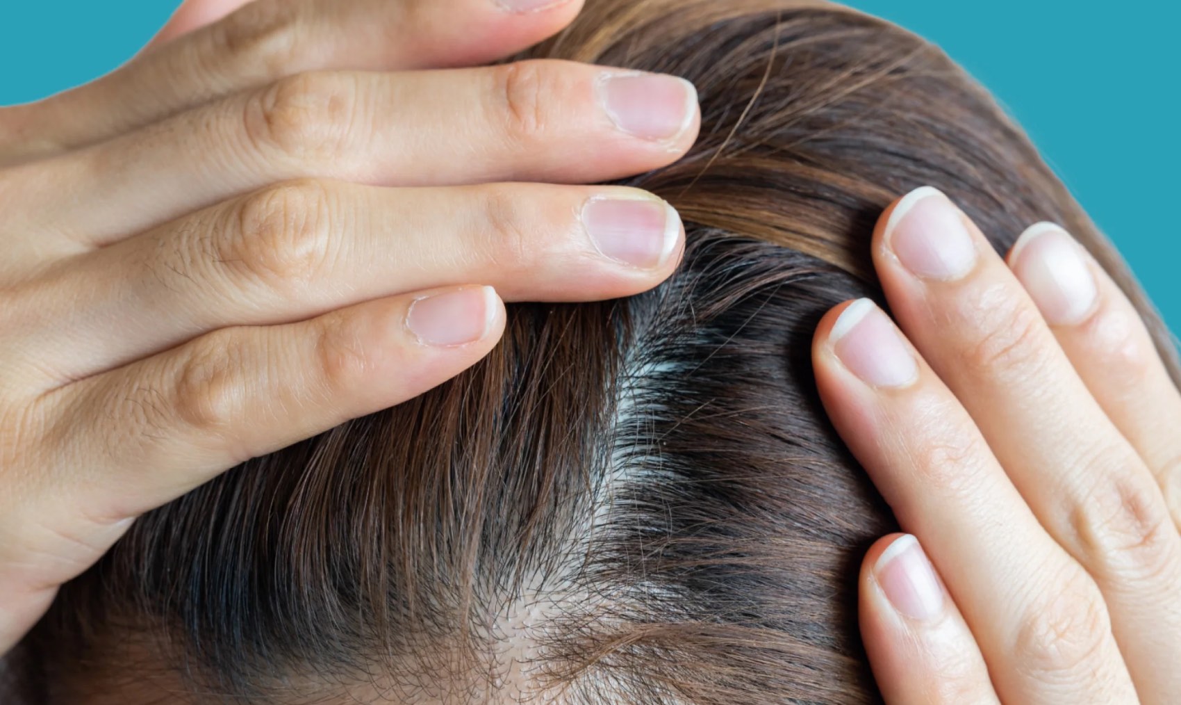 Como evitar a queda de cabelo por deficiência de ferro