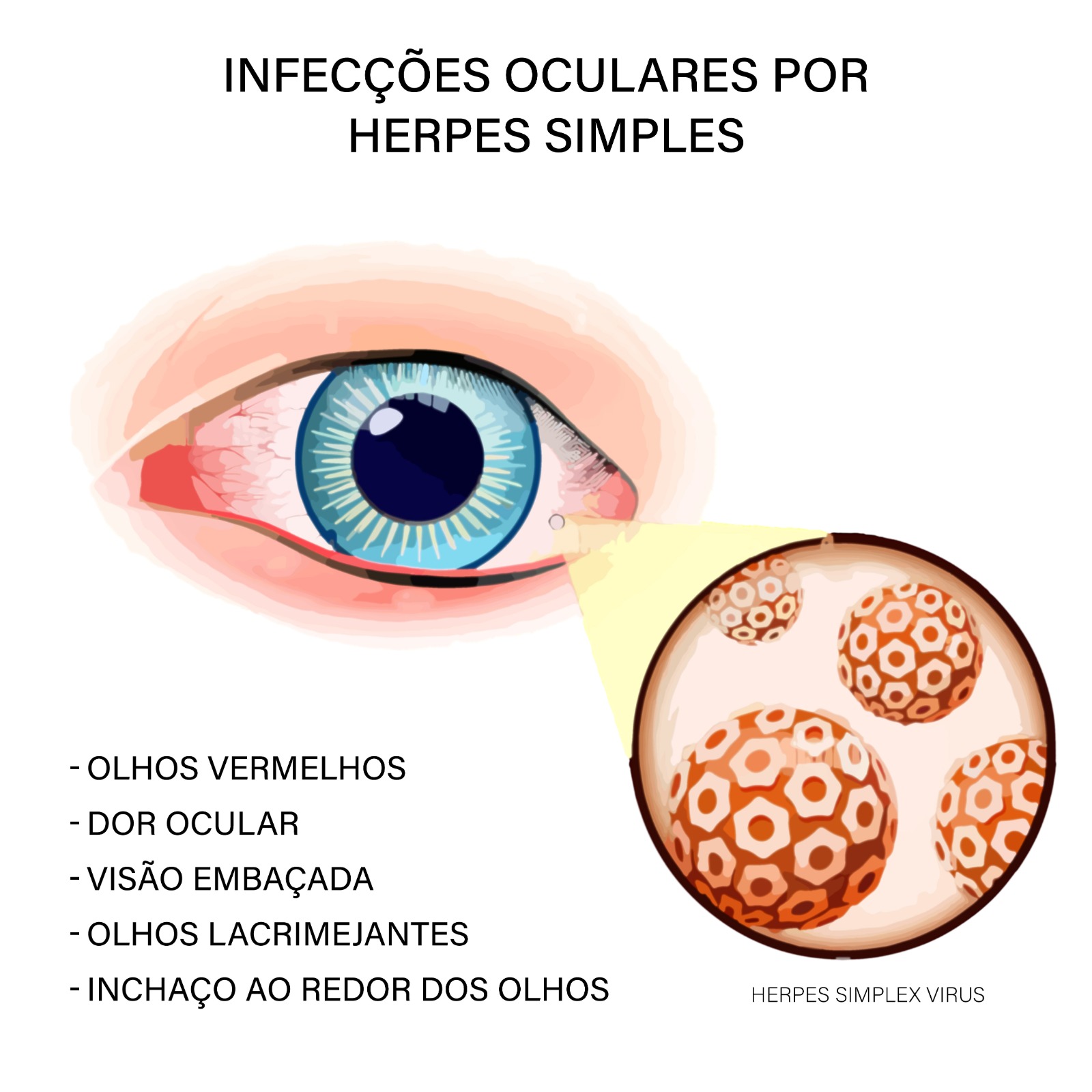 Como evitar a transmissão de herpes ocular