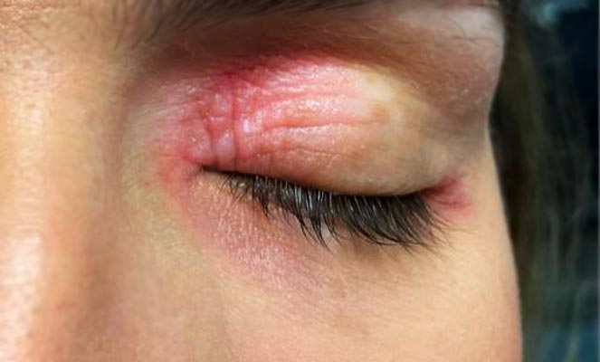 Como evitar a transmissão de herpes ocular