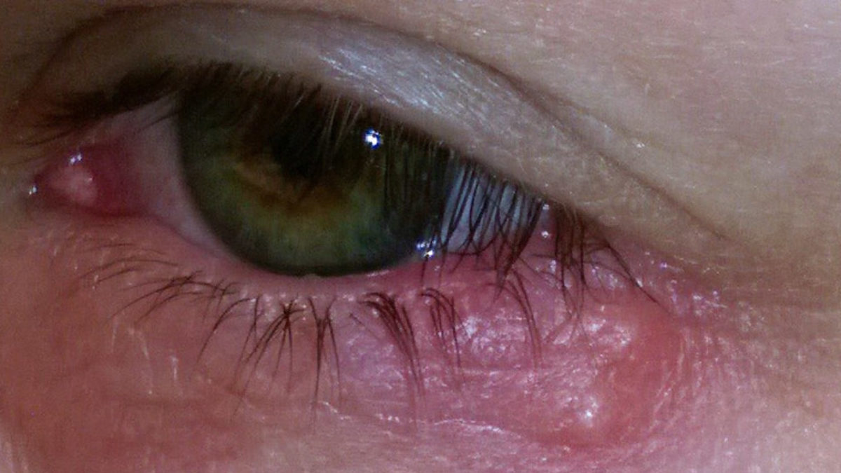 Como evitar a transmissão de herpes ocular