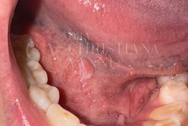 Sintomas do HPV na Boca: O Que Você Precisa Saber