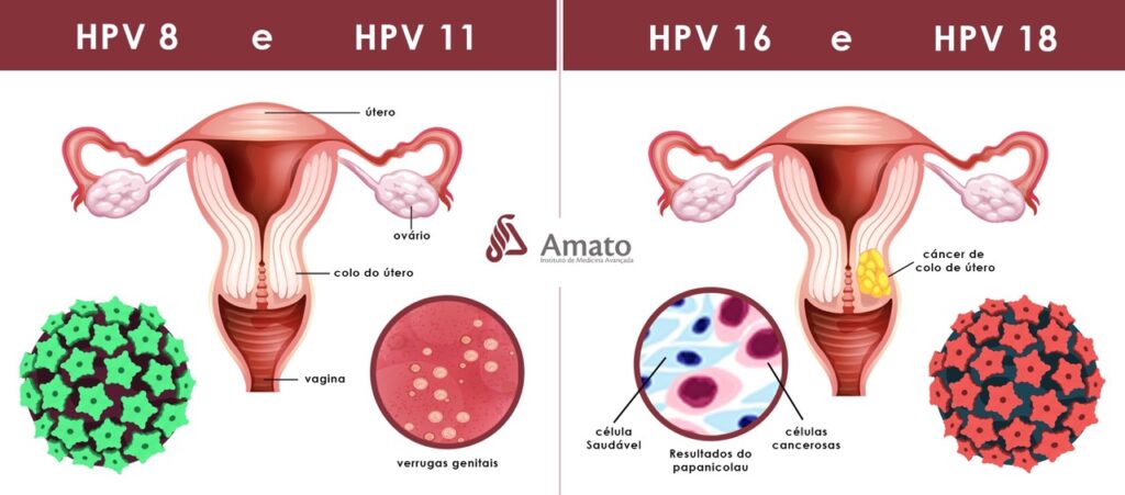 Como o HPV afeta a fertilidade feminina