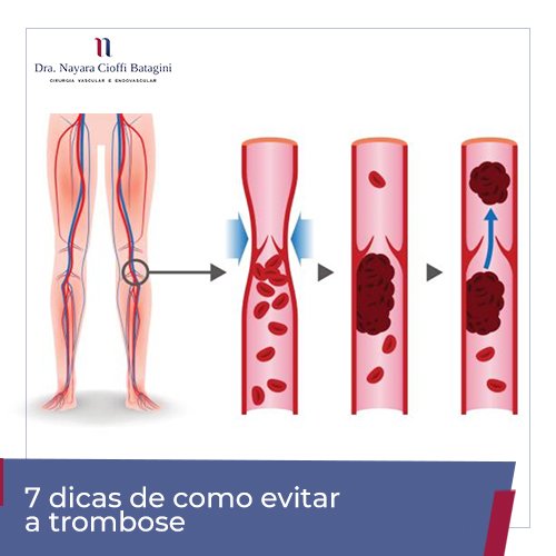 Como evitar a trombose
