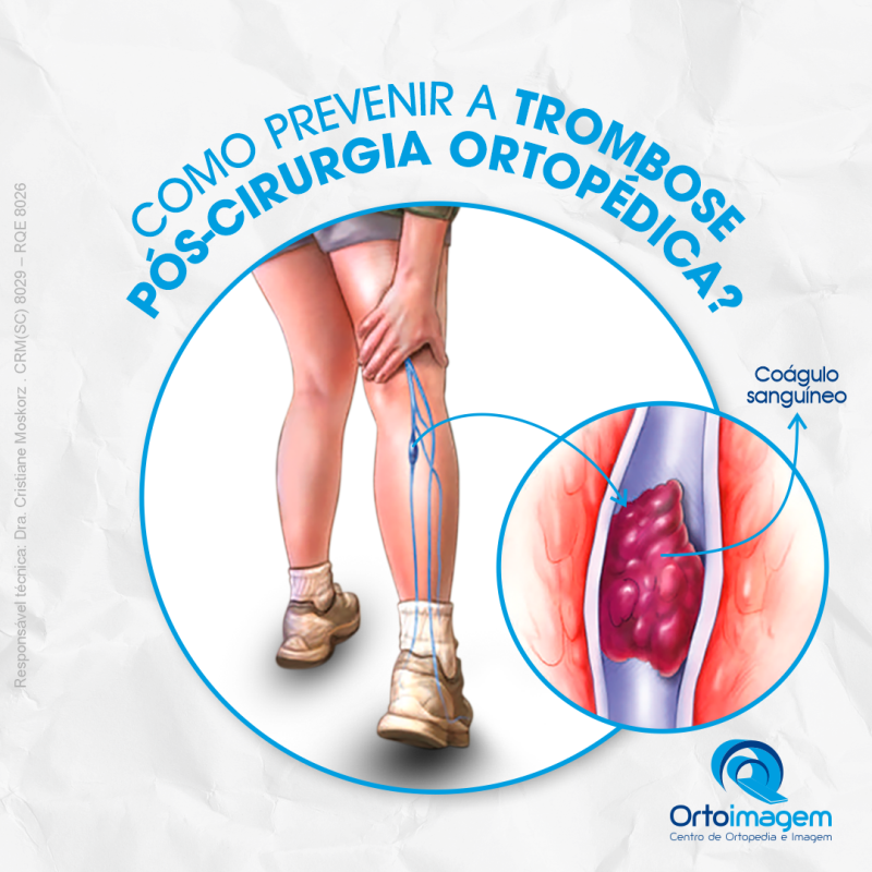 Como evitar a trombose