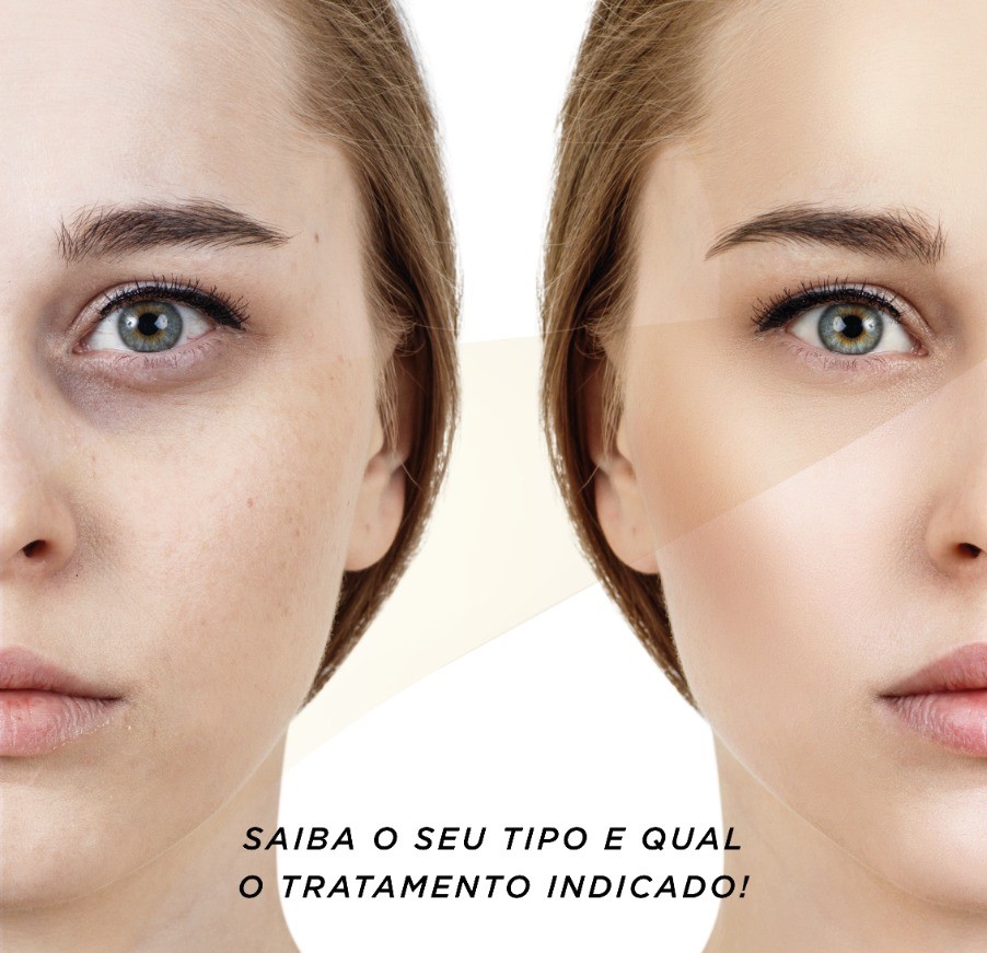 Como tirar olheiras profundas