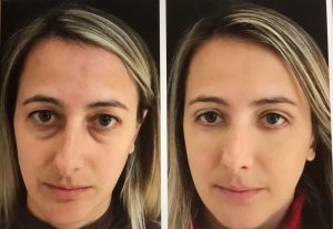 Como tirar olheiras profundas