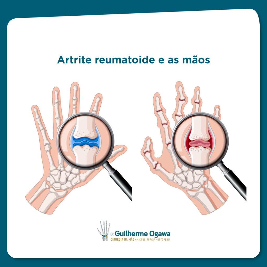 Dieta Anti-inflamatória para Artrite Reumatoide: O Que Comer e Evitar