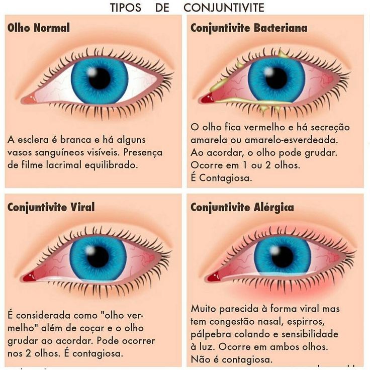 Como tratar a conjuntivite