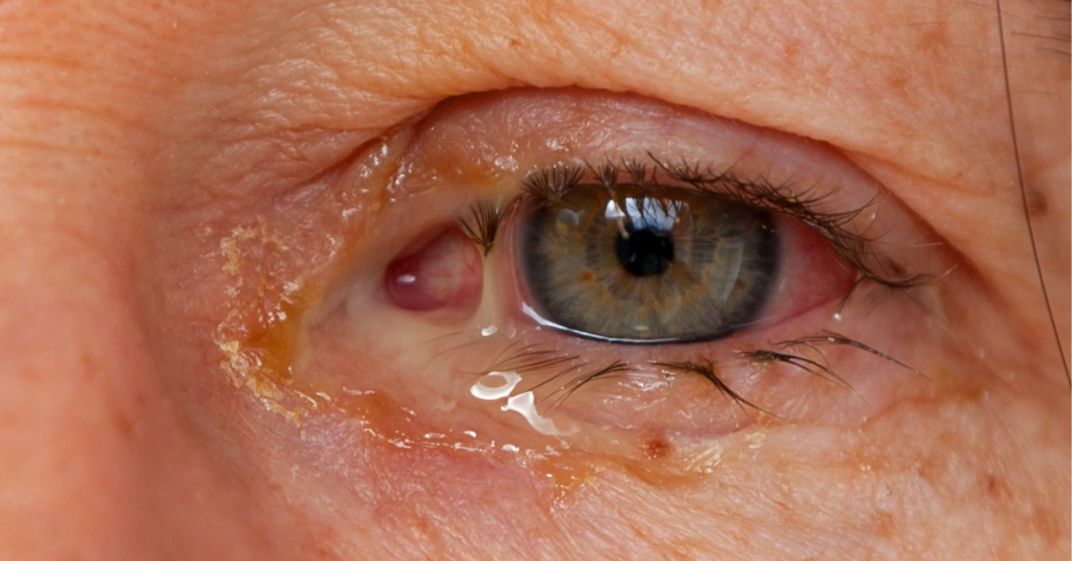 Quando Procurar um Oftalmologista para Conjuntivite