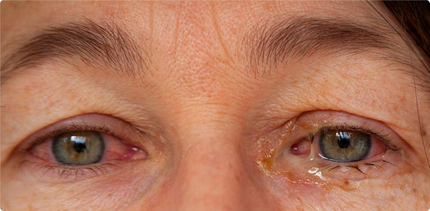 Tipos de Conjuntivite e Seus Tratamentos Específicos