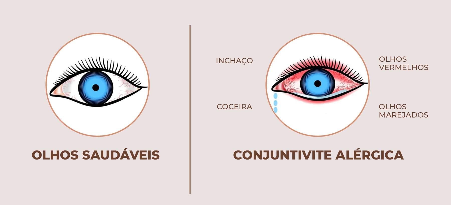 Como Aliviar o Desconforto da Conjuntivite em Casa