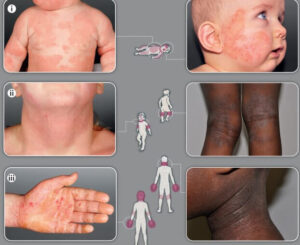 Cuidados contínuos e tópicos essenciais para quem tem dermatite atópica