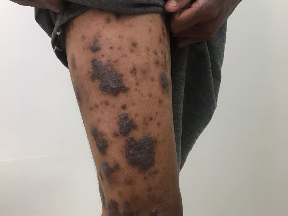 Como tratar a dermatite atópica grave