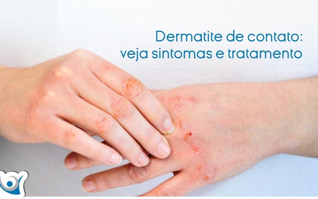 Como tratar a dermatite de contato