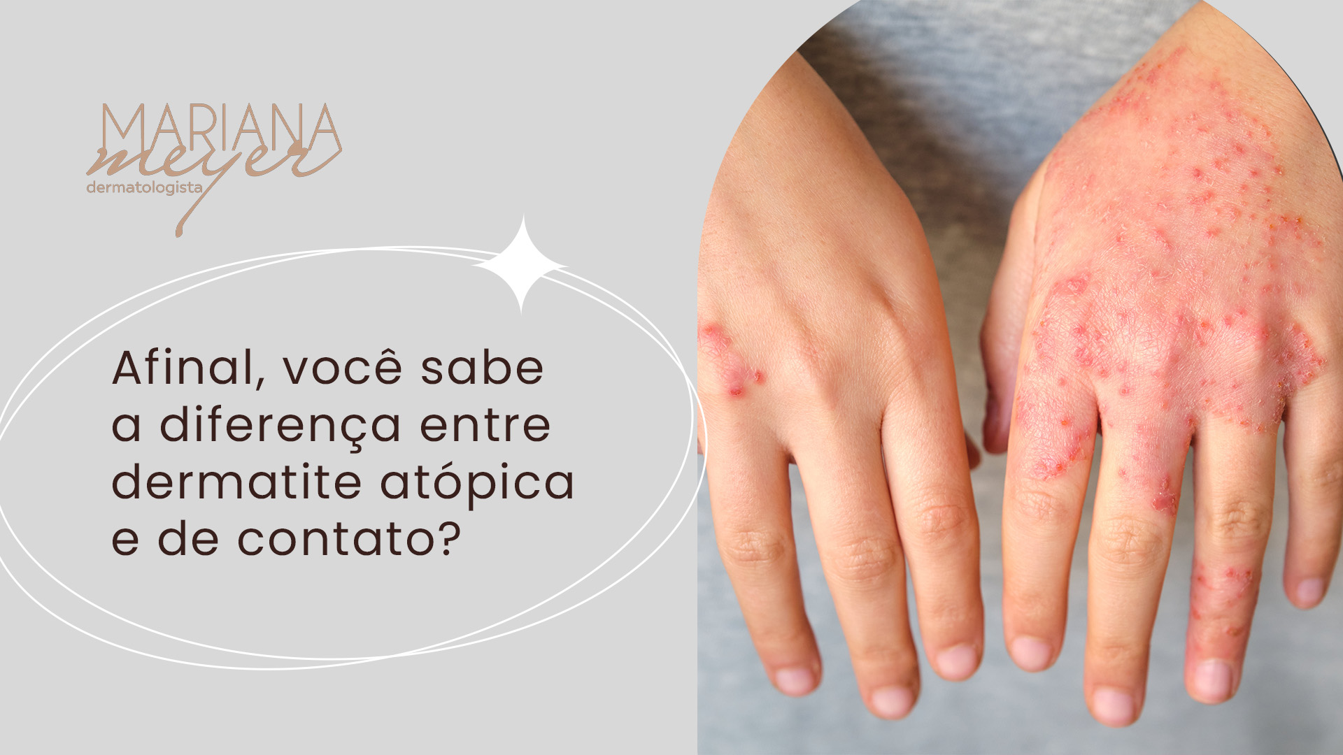Quando Procurar um Dermatologista para Dermatite de Contato?