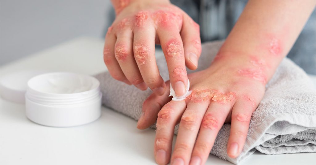 Guia Completo: Como Identificar e Evitar Substâncias Causadoras de Dermatite