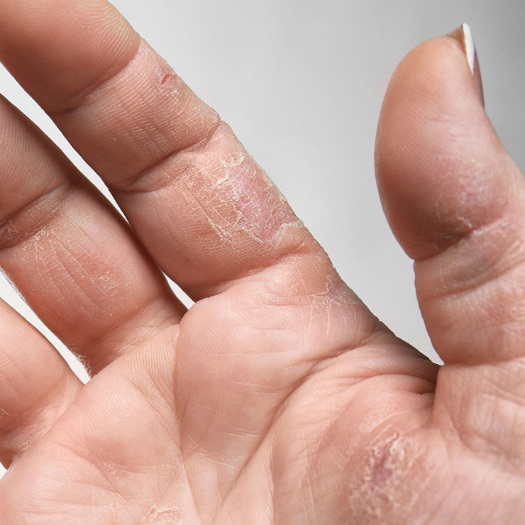 O Papel dos Corticoides e Anti-histamínicos no Tratamento da Dermatite de Contato