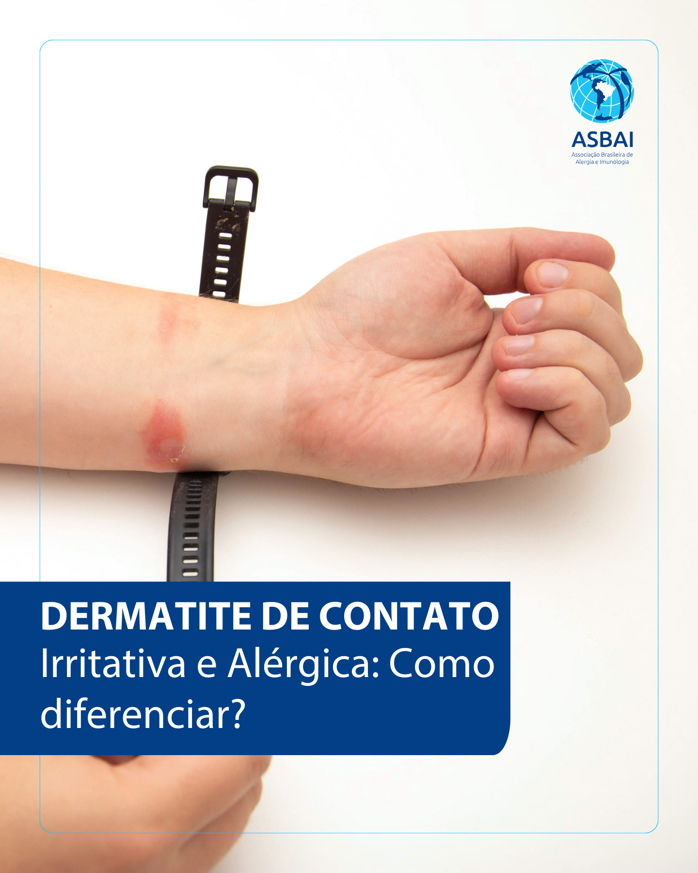Guia Completo: Como Identificar e Evitar Substâncias Causadoras de Dermatite