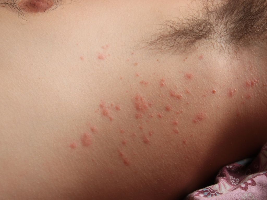 Como tratar a dermatite de contato por níquel