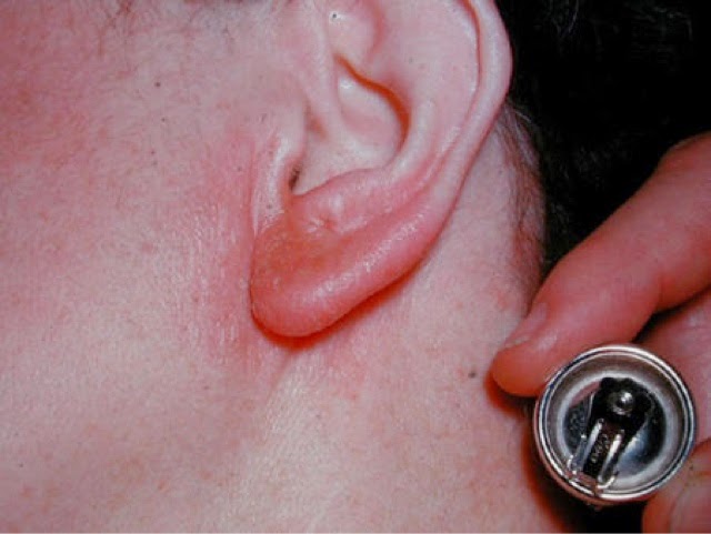 5 objetos comuns que causam alergia a níquel