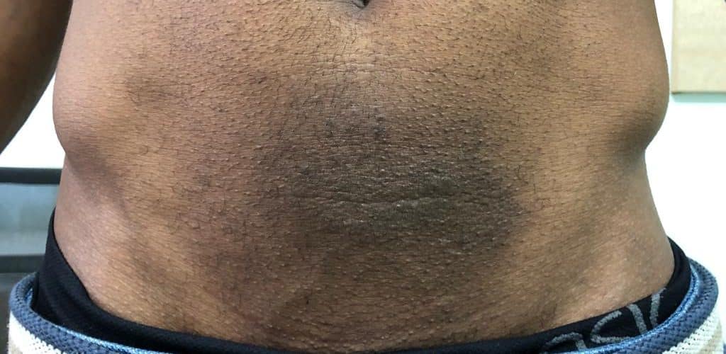 Gerenciando a coceira e inflamação da dermatite de contato por níquel