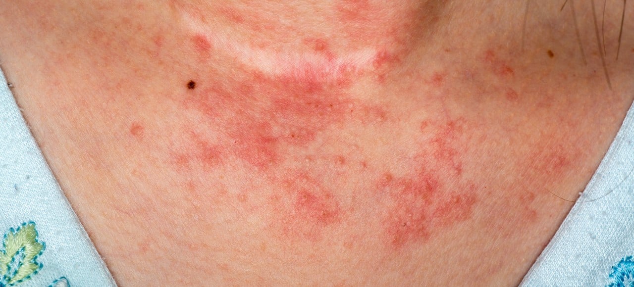 5 objetos comuns que causam alergia a níquel