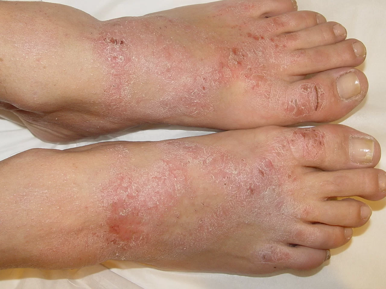 Guia completo de dieta com baixo teor de níquel