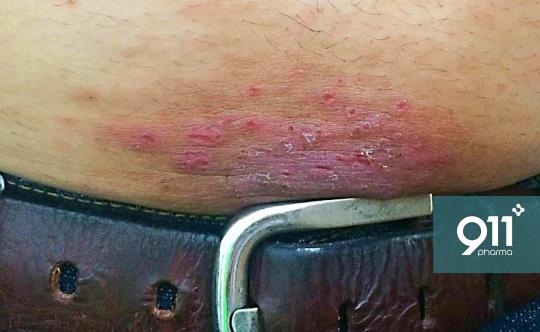 Como o teste de contato diagnostica a alergia a níquel