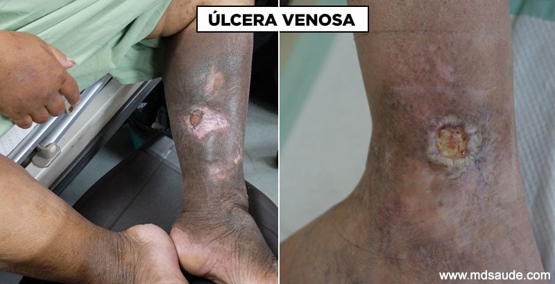 Como tratar a dermatite de estase ulcerada