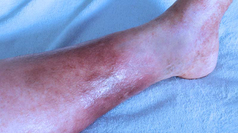 Como tratar a dermatite de estase ulcerada
