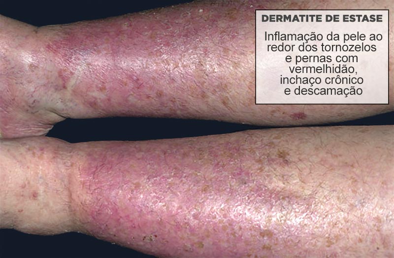 Como tratar a dermatite de estase venosa