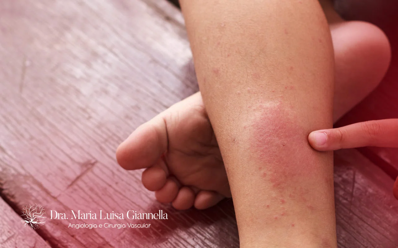 Como tratar a dermatite de estase venosa sem úlcera