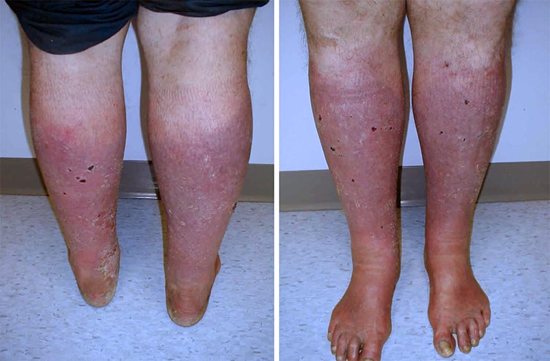 5 sinais de alerta da dermatite de estase venosa